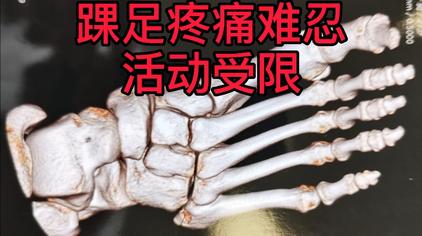 跖骨骨折护具 西瓜视频